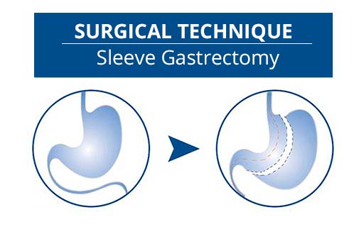 Sleeve Gastrectomy