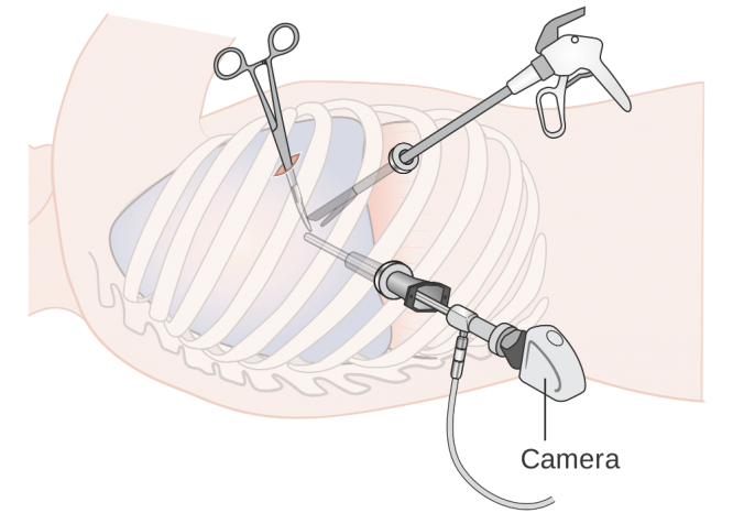 Esquema cirugia laparoscópica